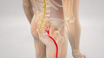 Do You Have Sciatica? | Symptoms of Sciatica